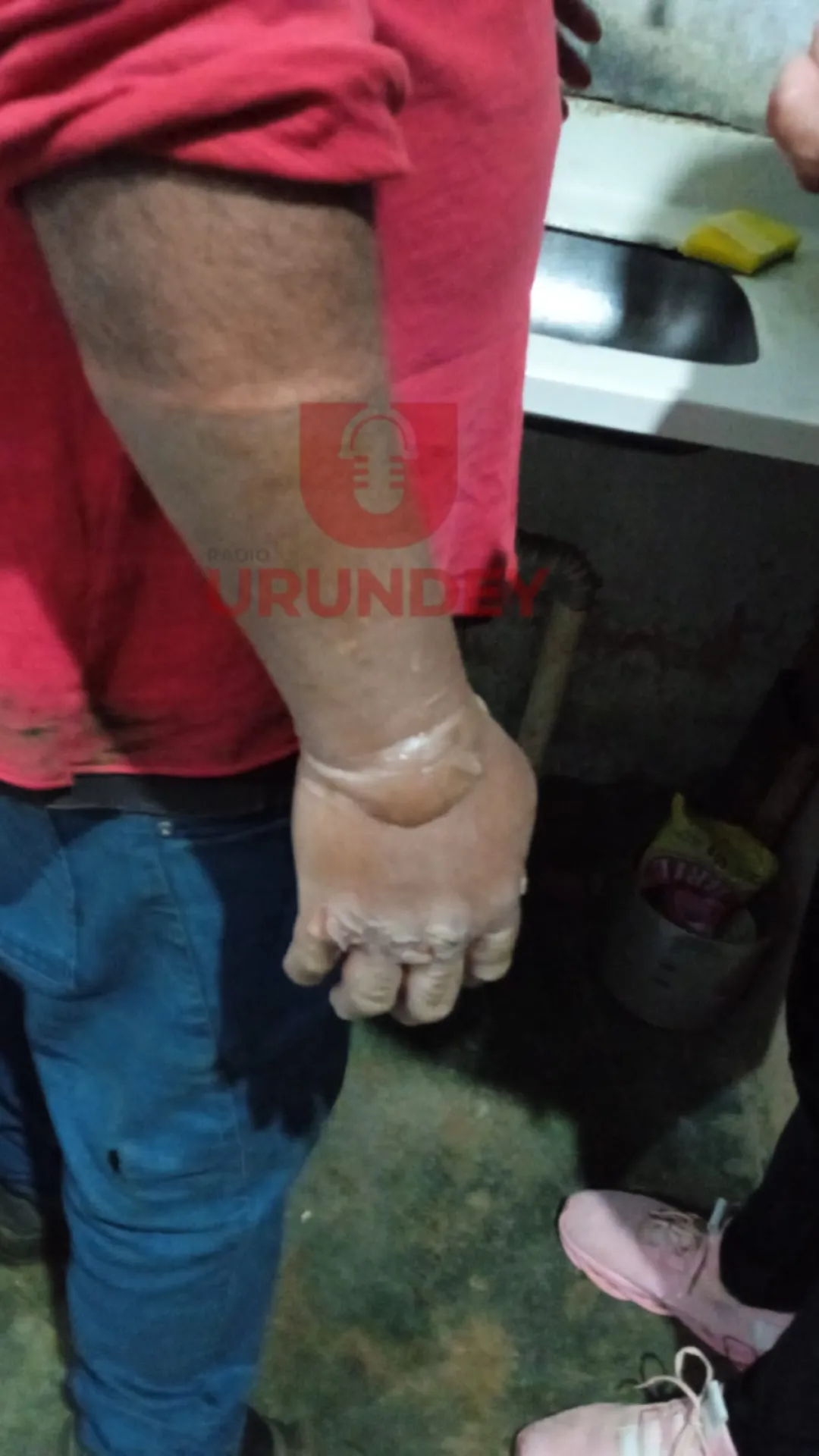 Hombre sufre quemaduras al manipular garrafa de gas en Zanja Pytã