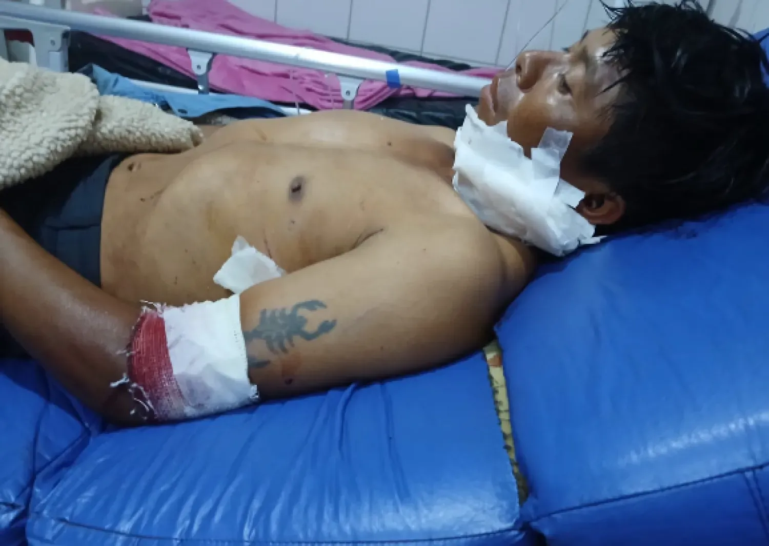 Nativo sufre grave herida de machetillo en el rostro tras discusión en Capitán Bado