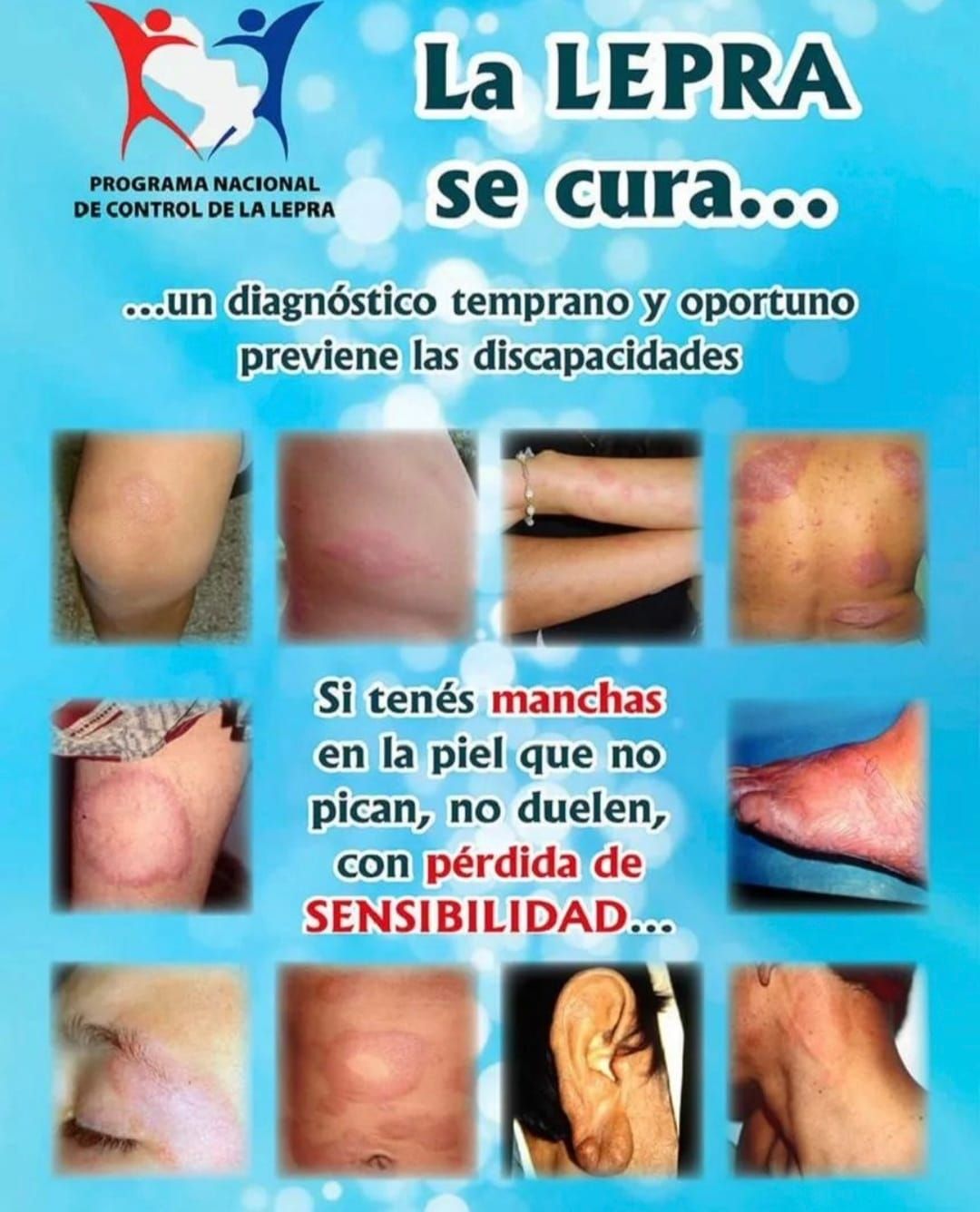 Lepra, su detección temprana es clave para un tratamiento proactivo