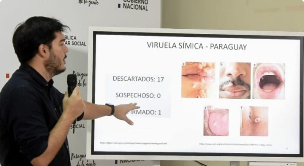 Viruela del mono: cuántos días de aislamiento se recomiendan a pacientes afectados