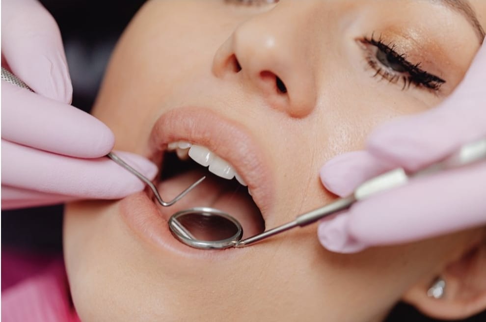 Sarro dental: cómo prevenir su aparición