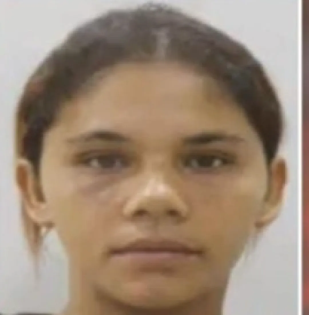 Joven quemada por su pareja en Pedro Juan Caballero pierde una pierna