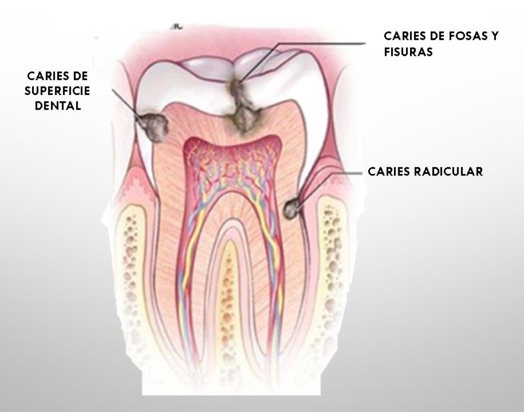 Las causas de las caries y cómo tratarlos