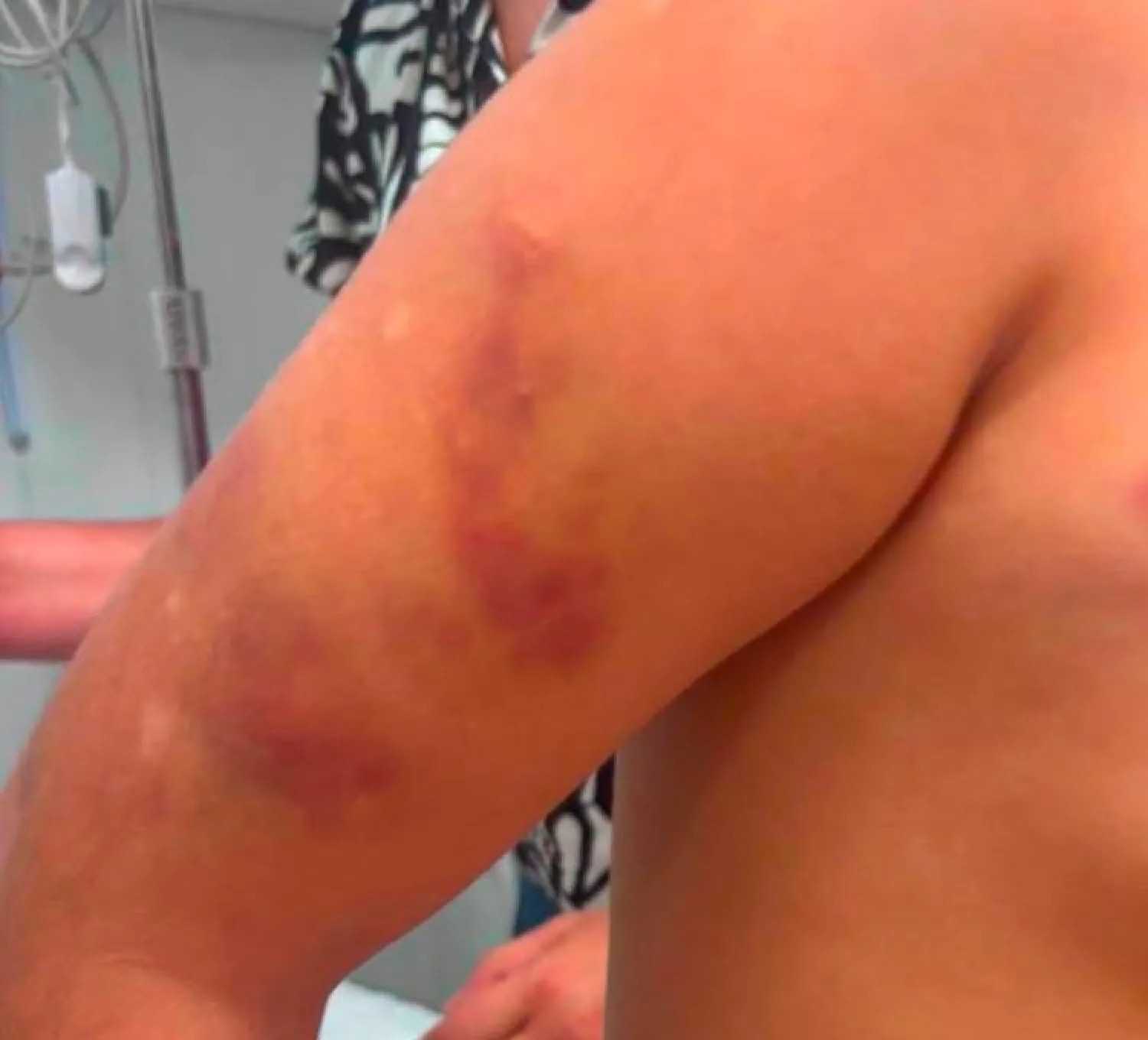 Forense detalla el estado de la niña autista golpeada por su padrastro en Pedro Juan